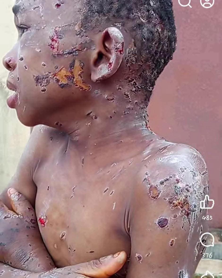 ANAMBRA GOVERNMENT RESCUES ABUSED 10-YEAR-OLD BOY, COMMISSIONER PLEDGES SWIFT JUSTICE